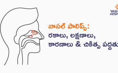 నాసల్ పాలిప్స్: రకాలు, లక్షణాలు, కారణాలు & చికిత్స పద్దతులు
