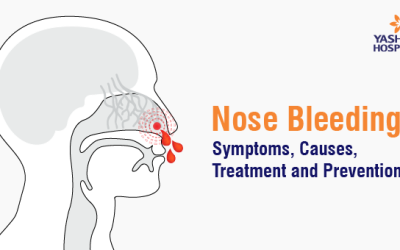 Nose Bleeding: Symptoms, Causes, Treatment and Prevention