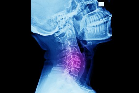 Shutter stock-and-resize Neck Back pain