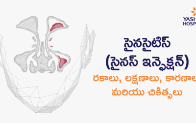 సైనసైటిస్ (సైనస్ ఇన్ఫెక్షన్): రకాలు, లక్షణాలు, కారణాలు మరియు చికిత్సలు