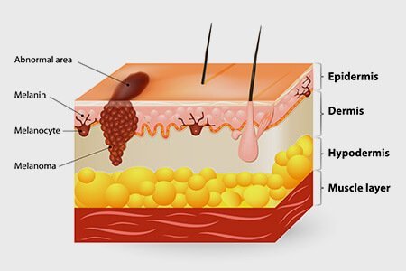 Skin Cancer or Melanoma