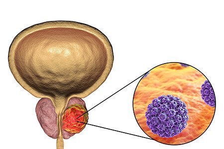 Prostate Cancer 