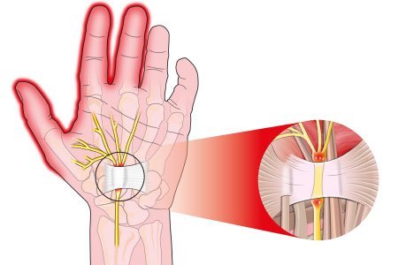 Ulnar Tunnel Syndrome