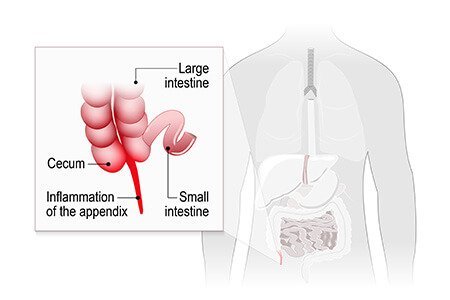 Appendicitis and appendectomy or appendicectomy  class=