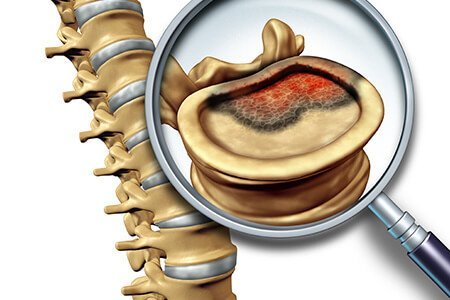 causes of bone cancer