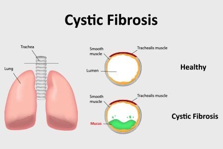 Cystic Fibrosis  class=