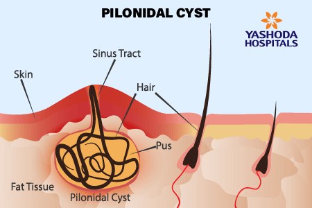 Pilonidal Cyst