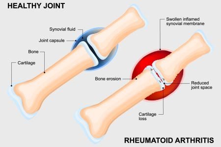 Rheumatoid Arthritis