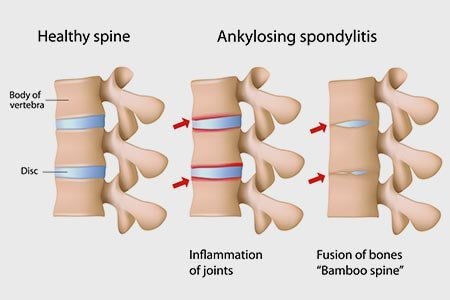 Spondyloarthritis