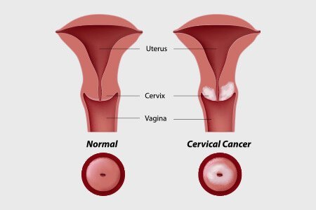 types of cervical cancer