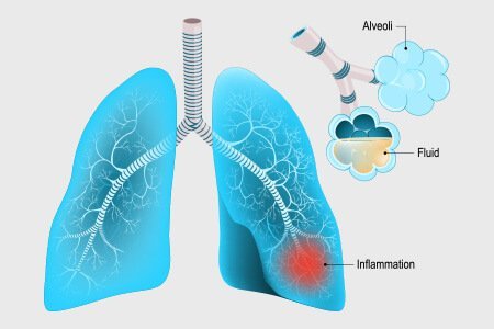 What is Respiratory Tract Infection (RTI)?