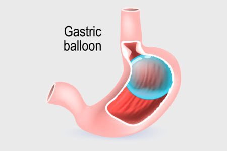 gastric balloon