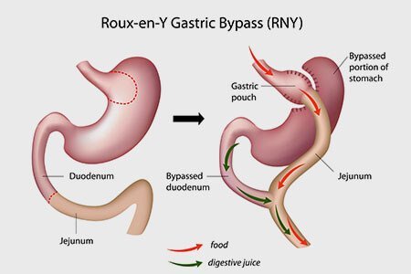 gastric bypass