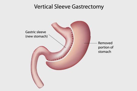 Sleeve Gastrectomy