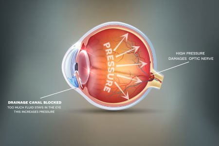 Glaucoma  class=