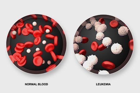 Leukemia