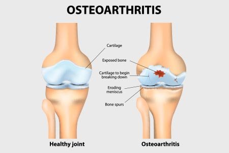 Osteoarthritis