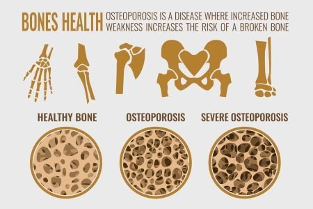 osteoporosis