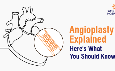 Angioplasty Explained: Here’s What You Should Know