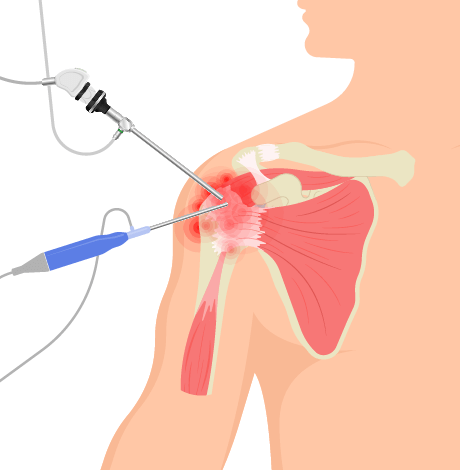 Shoulder Arthroscopy