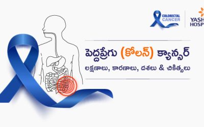పెద్దప్రేగు (కోలన్) క్యాన్సర్: లక్షణాలు, కారణాలు, దశలు & చికిత్సలు