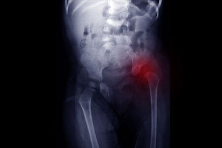  symptoms of Developmental Dysplasia Of The Hip