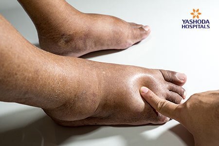 the symptoms of Diabetic Charcot Foot