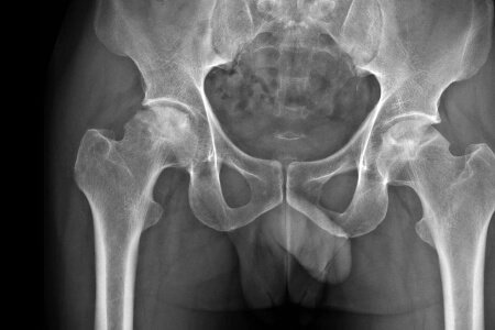 Hip Osteonecrosis