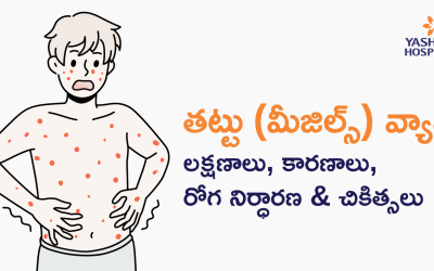తట్టు (మీజిల్స్) వ్యాధి: లక్షణాలు, కారణాలు, రోగ నిర్ధారణ & చికిత్సలు