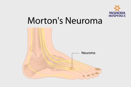  Morton’s Neuroma