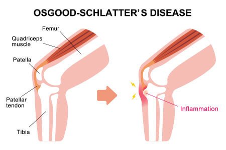  Osgood-Schlatter Disease