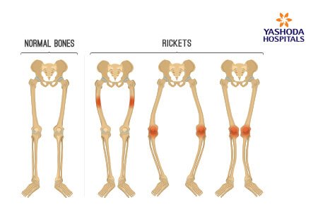 Osteomalacia