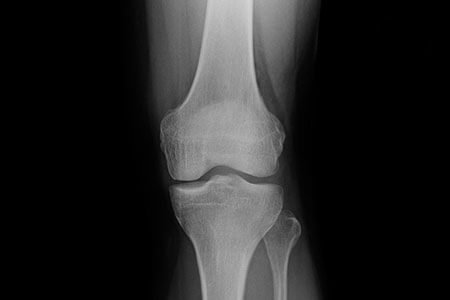 Osteonecrosis of the knee