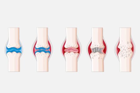 Osteonecrosis of the knee