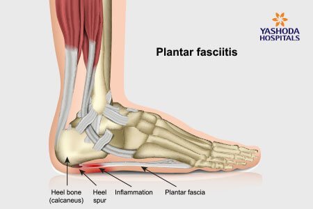 Plantar Fasciitis and Bone Spurs