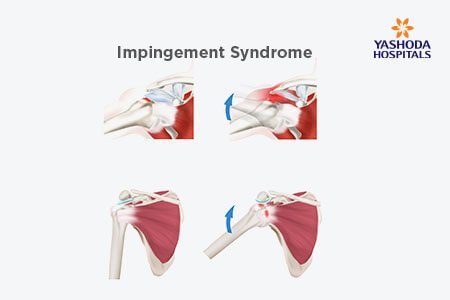 Shoulder Impingement 