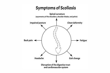 the symptoms of Scoliosis