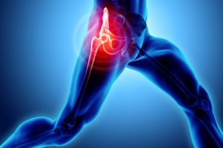 Snapping hip syndrome