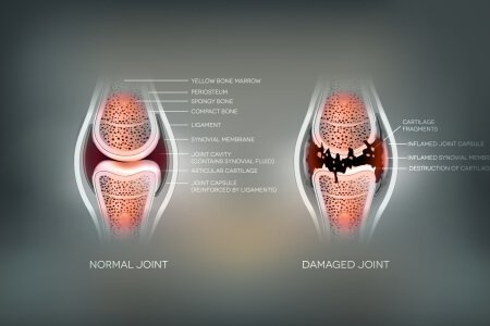 Synovial-Joinw