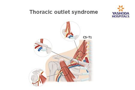 Thoracic Outlet Syndrome