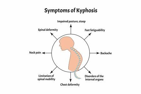 the symptoms of Kyphosis of the Spine