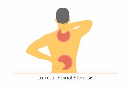  Lumbar Spinal Stenosis