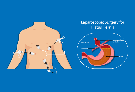 Epigastric Hernia Repair