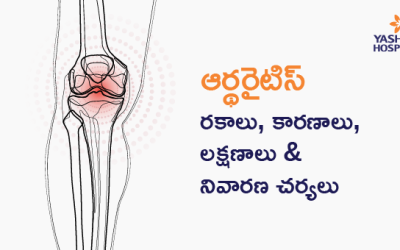 ఆర్థరైటిస్ (కీళ్లవాతం): రకాలు, కారణాలు, లక్షణాలు & నివారణ చర్యలు