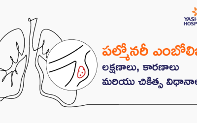 పల్మోనరీ ఎంబోలిజం: లక్షణాలు, కారణాలు మరియు చికిత్స విధానాలు