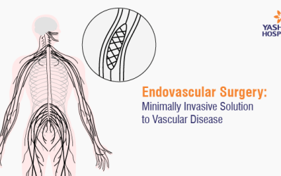 Endovascular Surgery: Minimally Invasive Solution to Vascular Disease