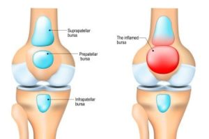 Knee Tendon Bursitis