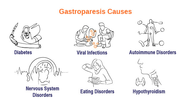Gastroparesis causes