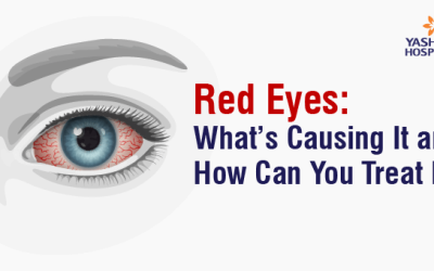 Red Eyes: What’s Causing It and How Can You Treat It?