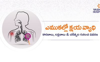 ఎముకల్లో క్షయ వ్యాధి: కారణాలు, లక్షణాలు & చికిత్సల గురించి వివరణ